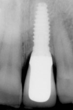 Implant2