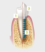 Implant2